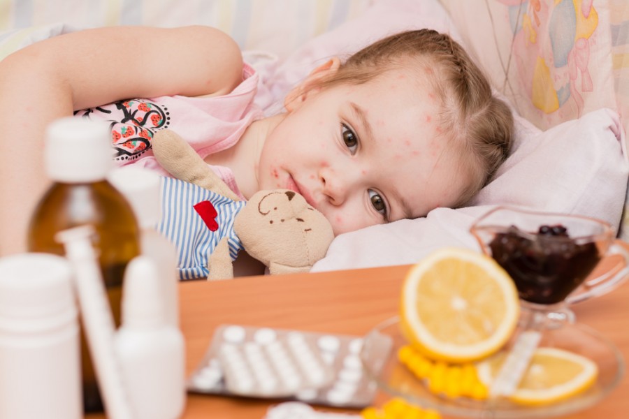 Sirop varicelle et autres solutions pour soulager les démangeaisons de l'enfant